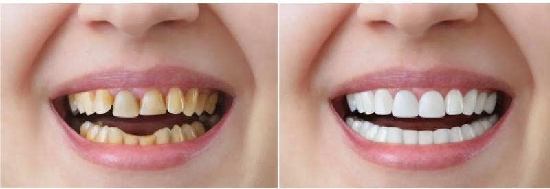 Tìm hiểu về mài răng bọc sứ