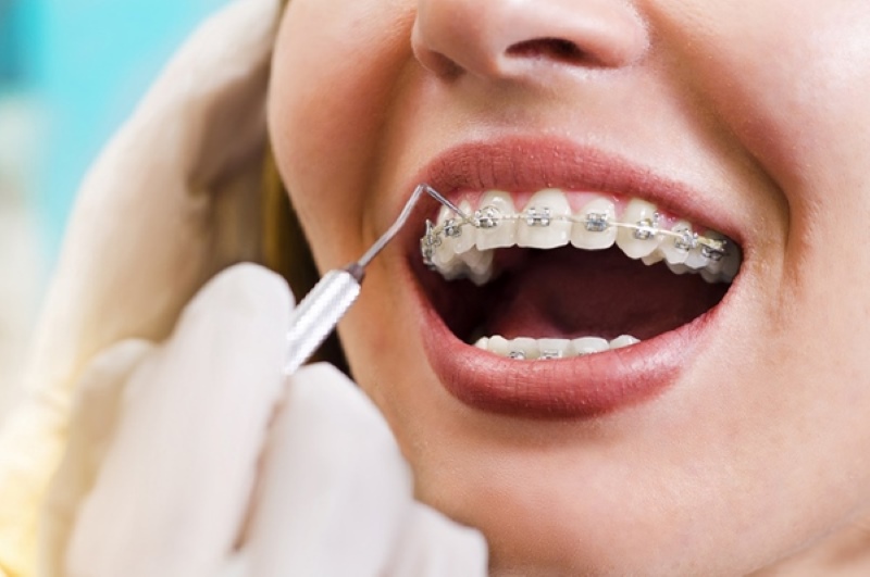 Tìm hiểu về khí cụ chỉnh nha