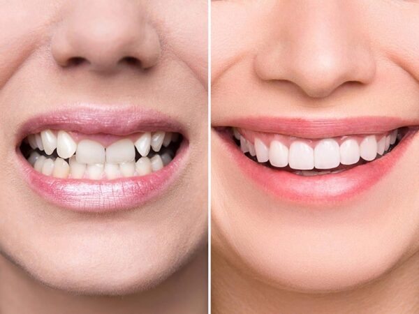 Lý do cần có quy trình bọc răng sứ đúng tiêu chuẩn