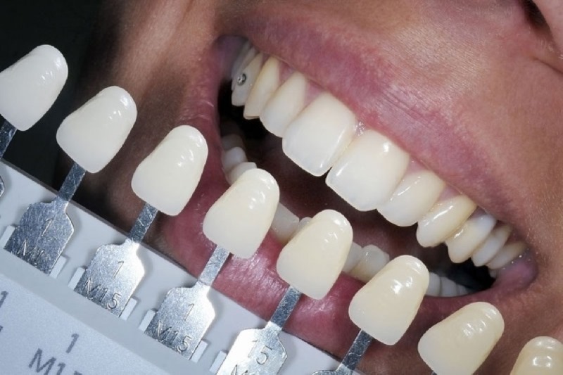 Ưu điểm của việc bọc răng sứ