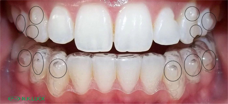 Attachments là các mấu nhỏ làm từ chất liệu composite