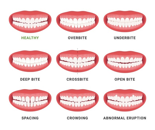 Một số trường hợp nên sử dụng dây thun liên hàm