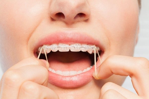 Một số điều quan trọng bạn cần lưu ý khi sử dụng dây thun liên hàm