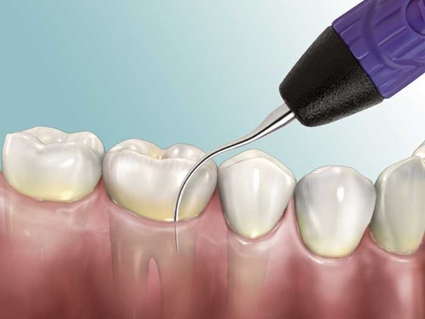 Ngăn ngừa viêm nướu và hôi miệng với dụng cụ lấy cao răng