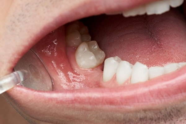 Sử dụng răng giả tháo lắp nhựa dẻo lâu sẽ xuất hiện tình trạng tiêu xương hàm 