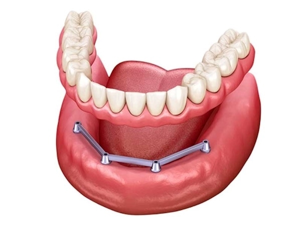 Hàm trên Implant