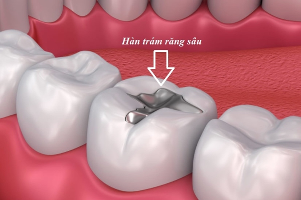 Trám răng sâu tạm thời