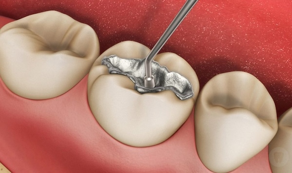 Trám răng tạm thời bằng kim loại Amalgam