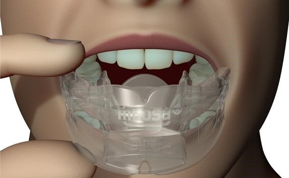 khí cụ myosa với thẻ lưỡi hướng lên trên