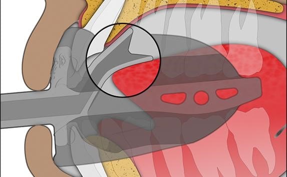 đặt khí cụ myosa vào miệng