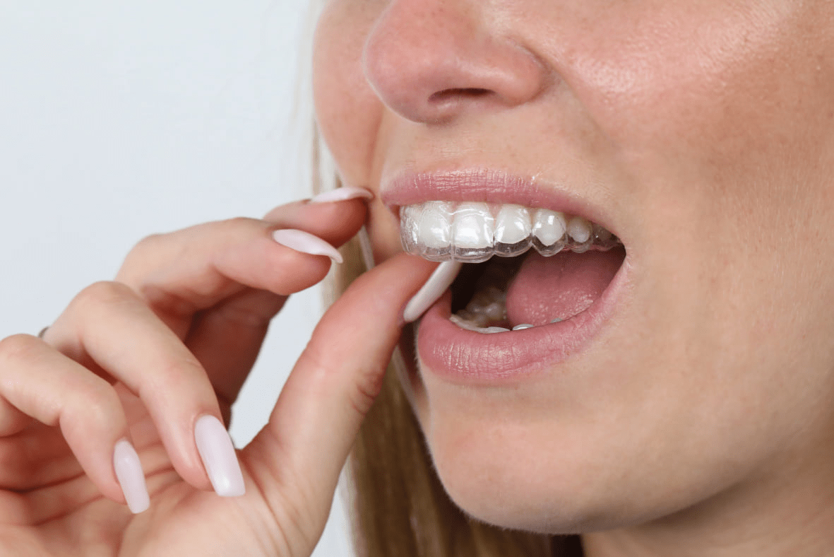 Khay chỉnh nha trong suốt CA Clear Aligner