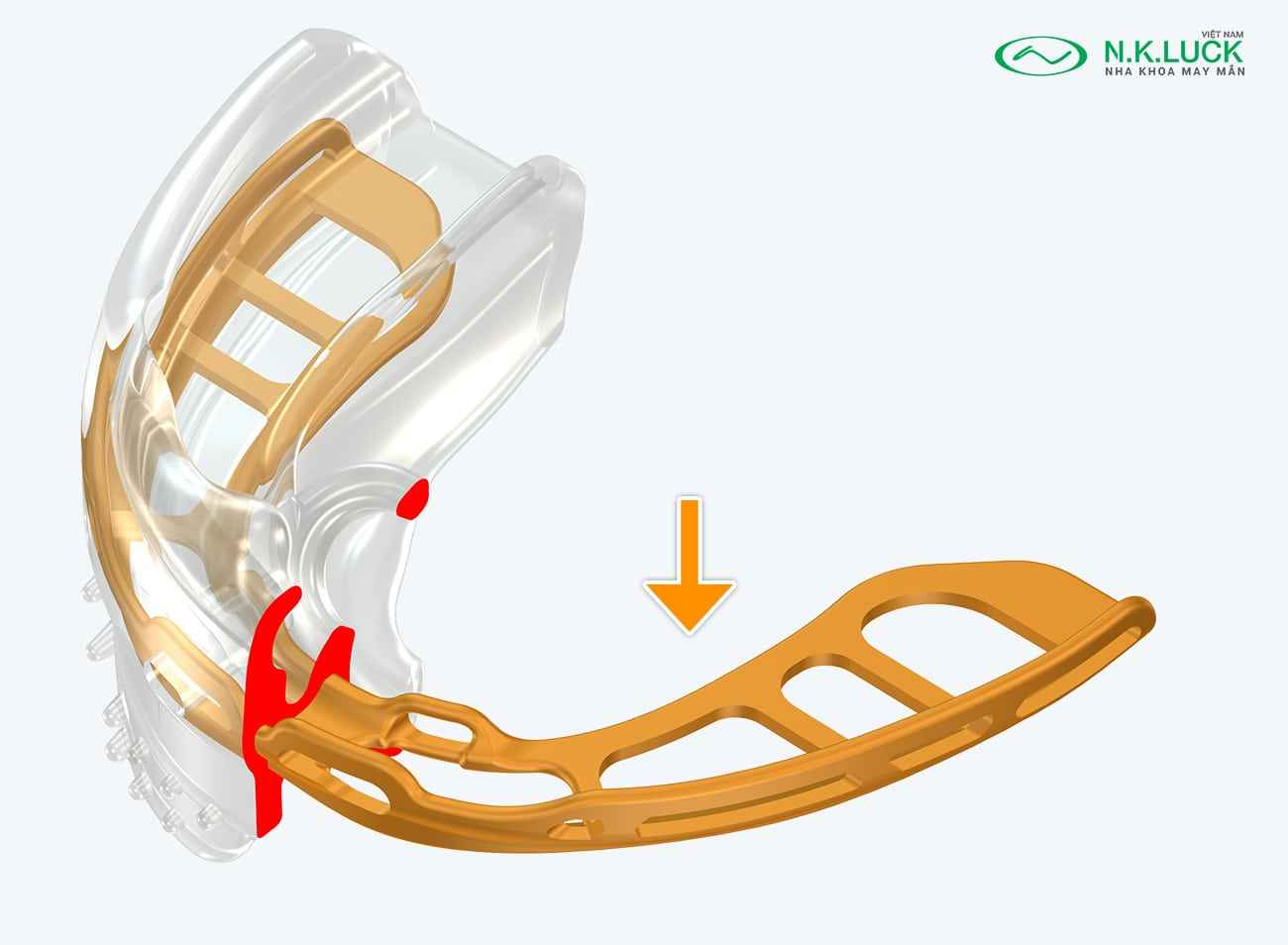 myobrace for brace B2 sau