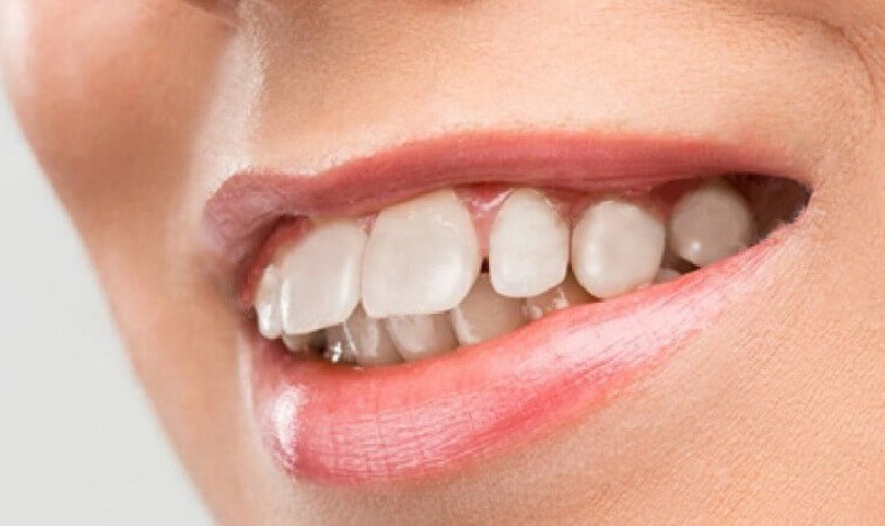 Răng hô, vẩu khiến gương mặt mất đi nét hài hòa