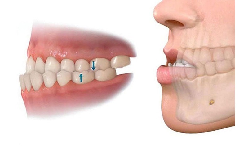 Răng móm ảnh hưởng đến chức năng nhai