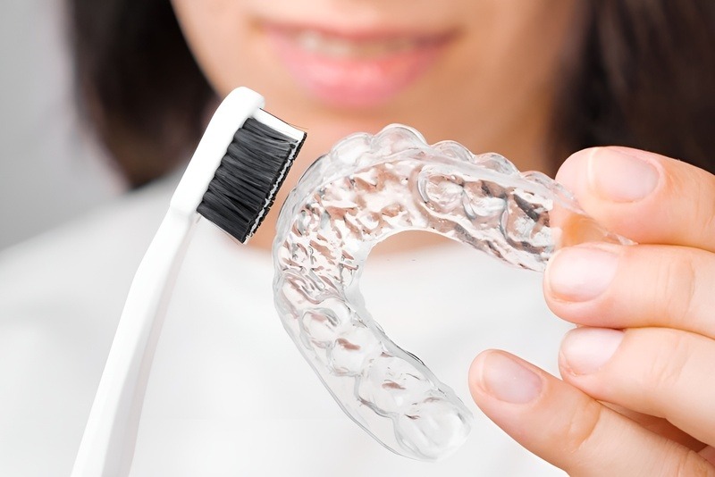Niềng răng không mắc cài tiện lợi, dễ dàng vệ sinh