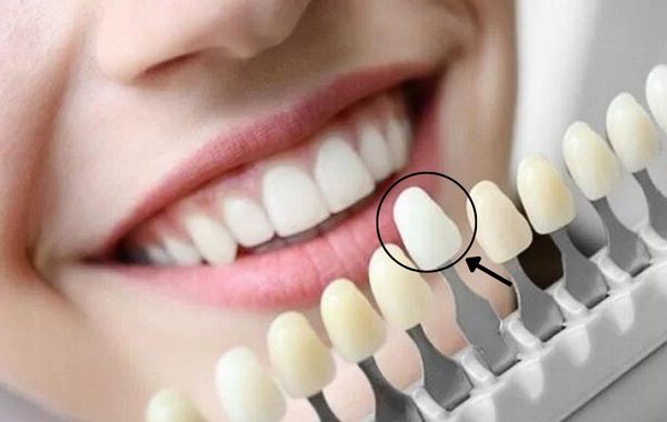 Chọn răng sứ theo màu răng thật là một trong những cách chọn màu răng sứ thẩm mỹ Chọn răng sứ theo màu răng thật là một trong những cách chọn màu răng sứ thẩm mỹ