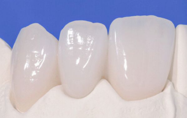 Răng sứ từ nguyên vật liệu sứ nha khoa thủy tinh Răng sứ từ nguyên vật liệu sứ nha khoa thủy tinh
