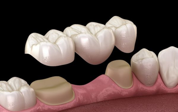 Phương pháp phục hình cầu răng Phương pháp phục hình cầu răng