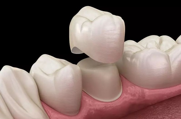 Nguyên tắc mài cùi răng đẹp và đạt chuẩn Nguyên tắc mài cùi răng đẹp và đạt chuẩn