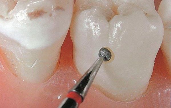 Cần tiệt trùng khuẩn mũi khoan nha khoa sau khi dùng để tránh nhiễm khuẩn Cần tiệt trùng khuẩn mũi khoan nha khoa sau khi dùng để tránh nhiễm khuẩn